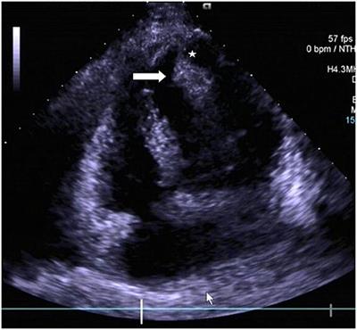 Surgical Management for a Rare Pedunculated Left Ventricular Apical Lipoma: A Case Report and Review of Literature